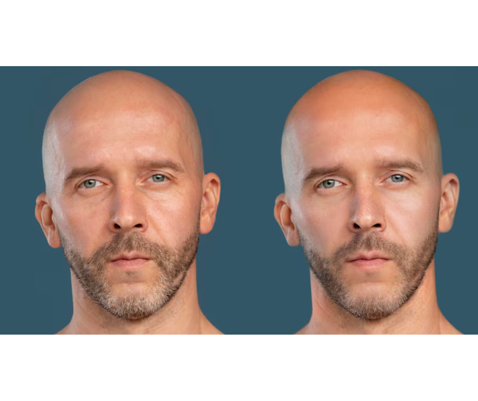 Testosterone therapy before and after pictures